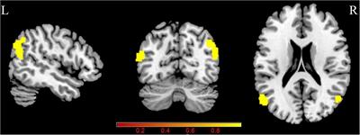 Altered Neurovascular Coupling in Unilateral Pulsatile Tinnitus